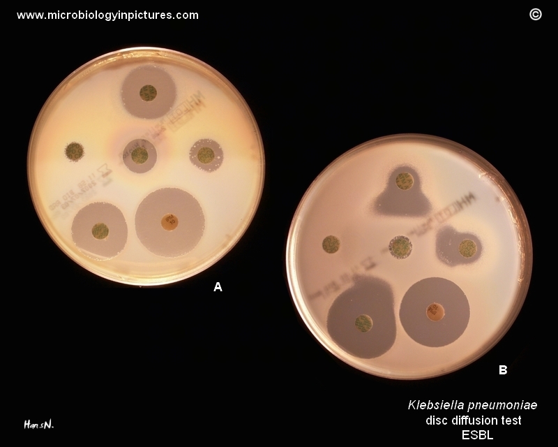 Klebsiella pneumoniae ESBL evidence